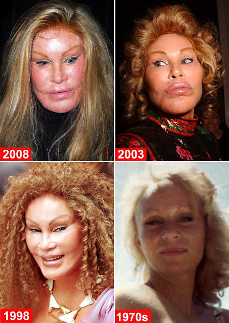 Celebrity Plastic Surgery Gone Wrong Before And After