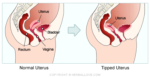 Tilted Uterus And Sex 70