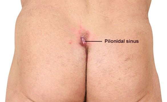Pilonidal Cyst Symptoms, Treatments, Surgery, & More