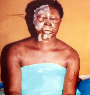 Graphic Photo: Man Sends Thugs To Pour Acid On Ex-Wife
