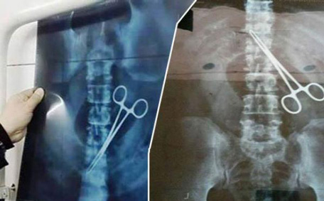 Photo: Scissors Found In Nigeria Pilgrim's Stomach In Saudi Arabia