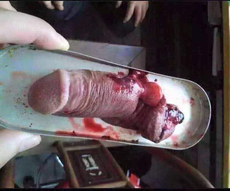 Small Cuts On Penis 41