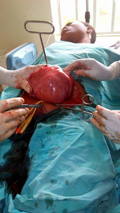 See The Massive Fibroid Doctors Removed From A Woman's Stomach. Graphic Photos 4605531_maco1_jpegb08360ac6cf009e15e2fb43259aaf2dd