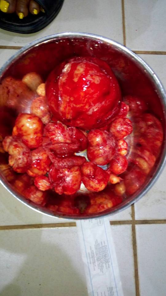See The Massive Fibroid Doctors Removed From A Woman's Stomach. Graphic Photos 4605533_maco3_jpg2ddc10542df00ba081ab5ddd11bf1786