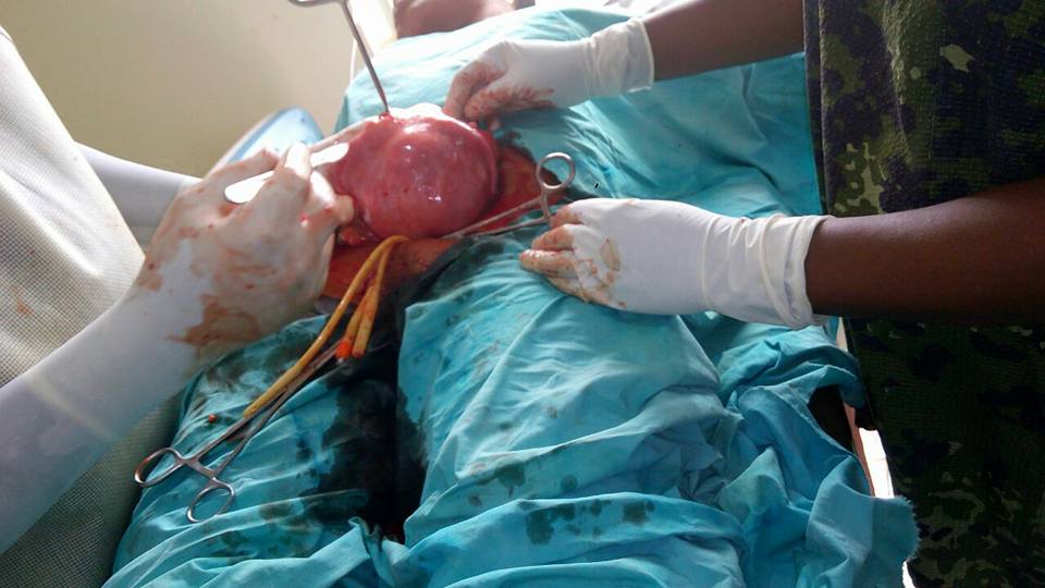 See The Massive Fibroid Doctors Removed From A Woman's Stomach. Graphic Photos 4605537_maco5_jpga06122a1e298da80b6b6cec2fced1bb9
