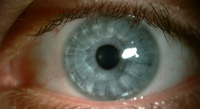 What are the risks of corneal transplant surgery?