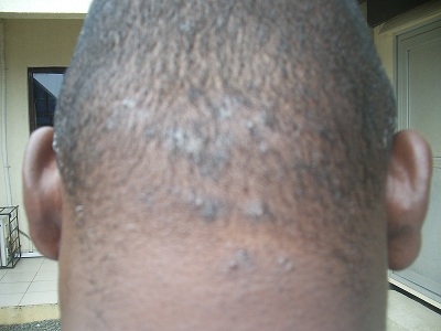 Neck rash and Small raised bumps - Right Diagnosis