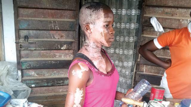 Girl Bathed With Acid On Her 14th Birthday In Lagos (Photo) 5119444_acidbath640x360_jpeg2822ded3db4dc4cb9e37ca9824d43519