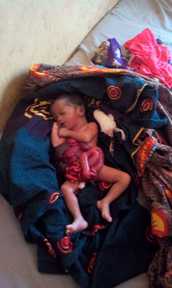 Baby Born With Internal Organs Outside The Body In Benue State (Disturbing Photos) 6527538_fbimg1515510157699_jpeg18a76d9824ad35589a73c8cbd5163c53