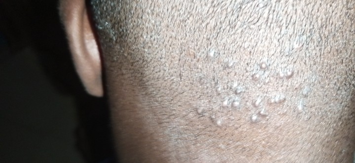 Bump At The Back Of My Head After Haircut Pls Help Me Get Rid Of This Health Nigeria