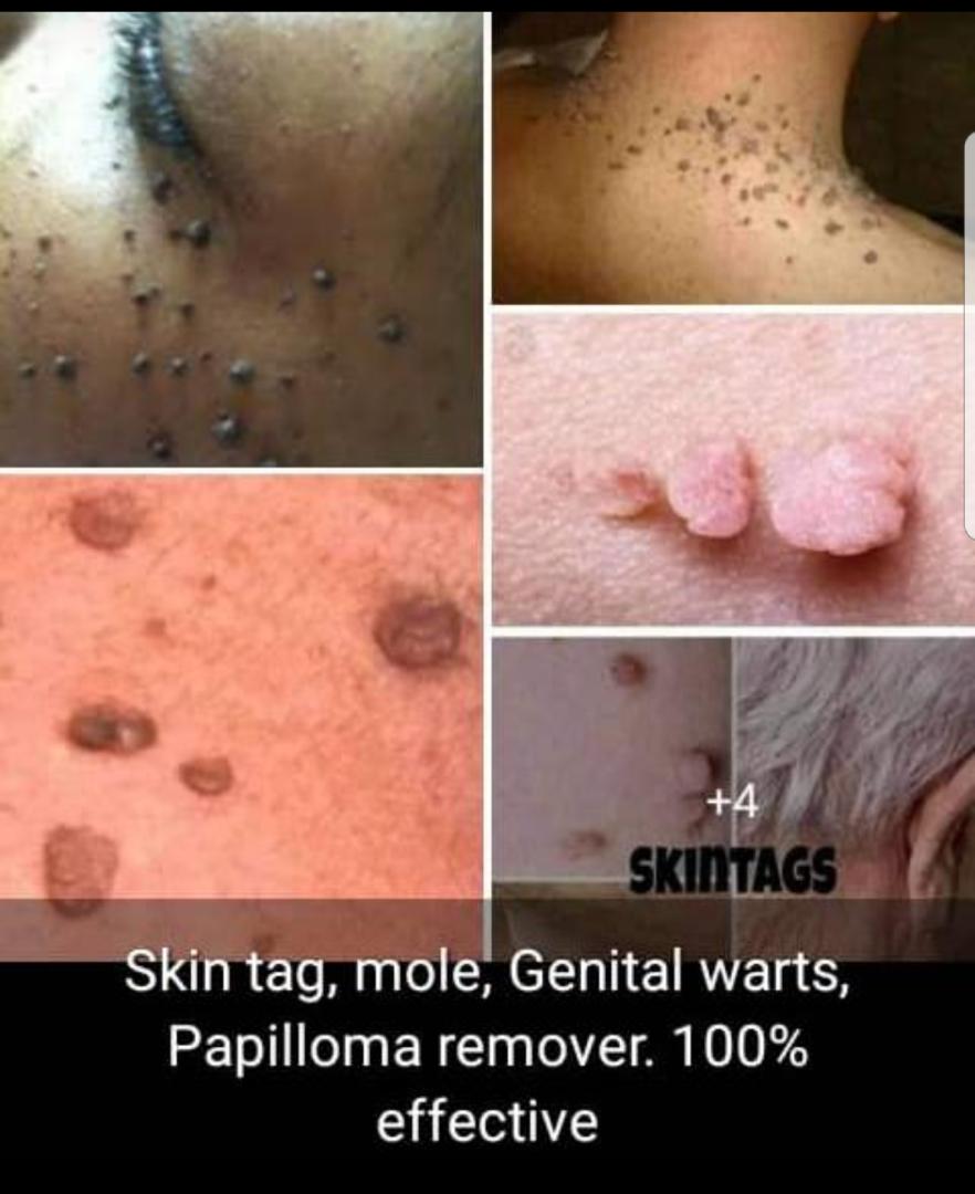 how to get rid of warts at home