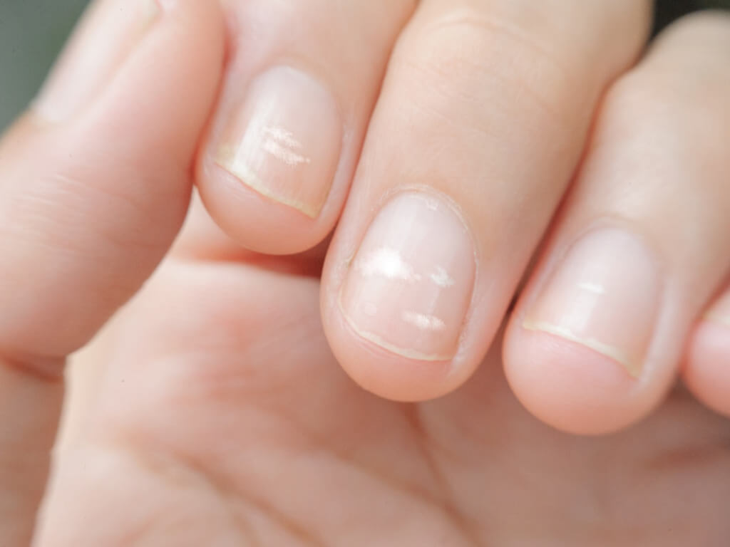 Little White Spots On Your Finger Or Toenailsthis Is What It Means