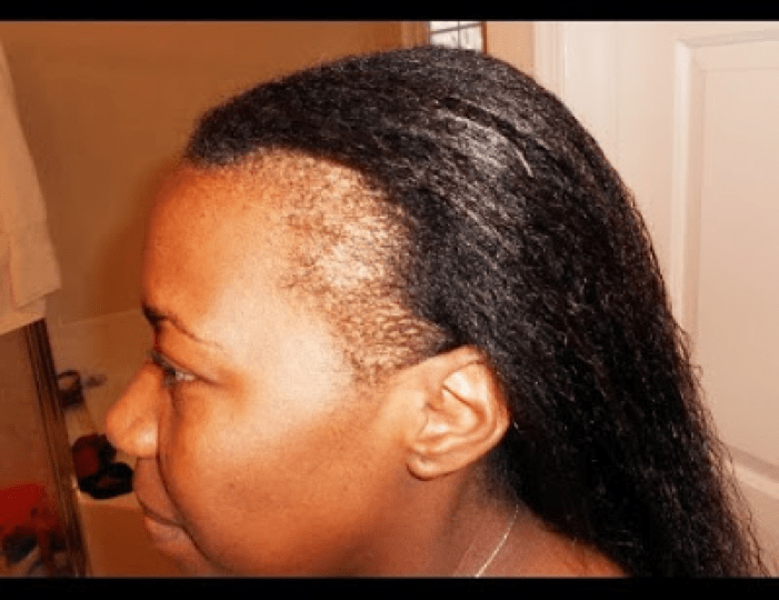 Tips To Treat Hair Breakage And Thinning - Fashion - Nigeria
