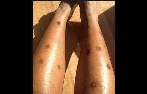 They lied! How to REALLY remove dark spots on thighs