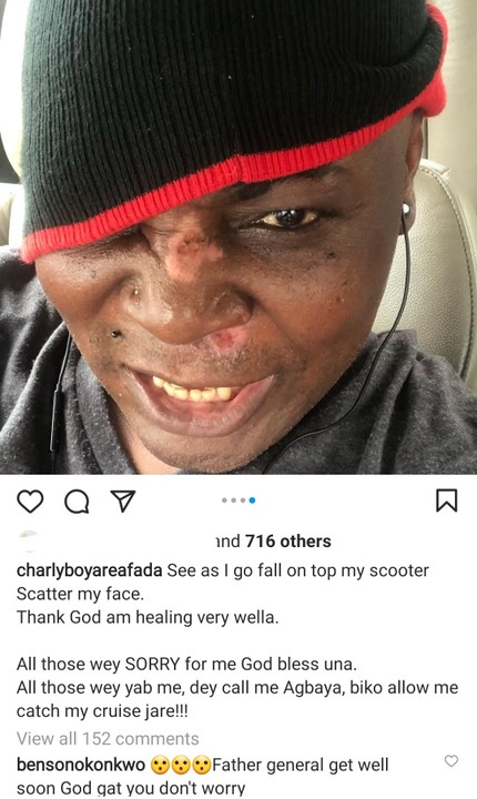 Charly Boy Injured On His Face After Falling On His Scooter (Photos)