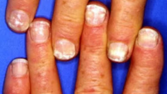 If You Notice White Spots Of Your Nails, This Is What It Means According To  Expe - Health - Nigeria