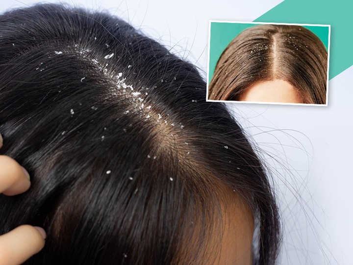 How To Get Rid Of Dandruff On Hair: Best Tips - Health - Nigeria