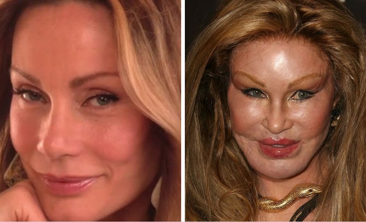 15 Celebrities Whose Plastic Surgeries Went Wrong Pics Celebrities