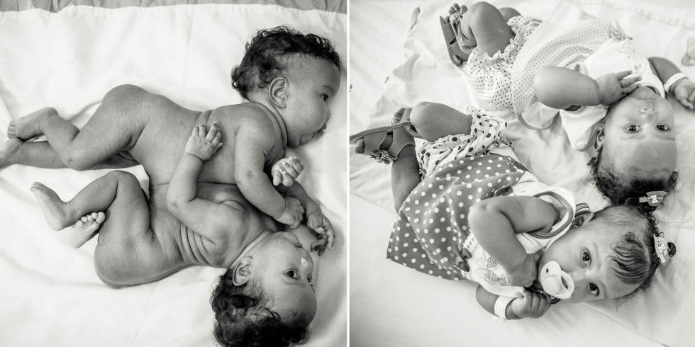 Photos of conjoined twins Maria Clara and Maria Eduarda Oliveira Santana bo...