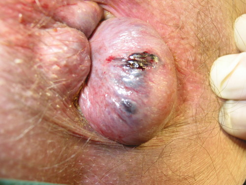 Image result for hemorrhoids operation