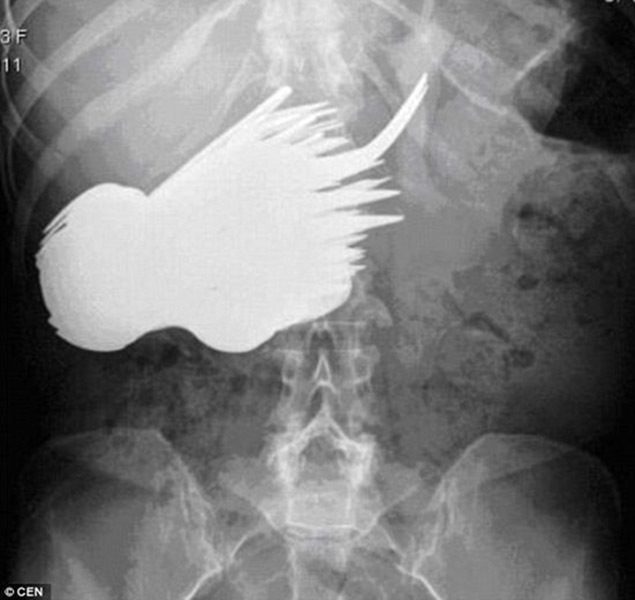 Funny X-ray Images: 30 Of The Most Unbelievably Weird X-rays You`ll Ever  See - Health - Nigeria