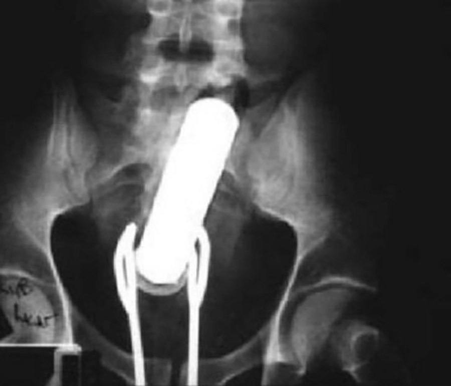 Funny X-ray Images: 30 Of The Most Unbelievably Weird X-rays You`ll Ev...