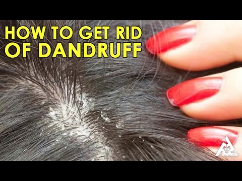 4 Home Made Remedies That Get Rid Of Dandruff - Health photo