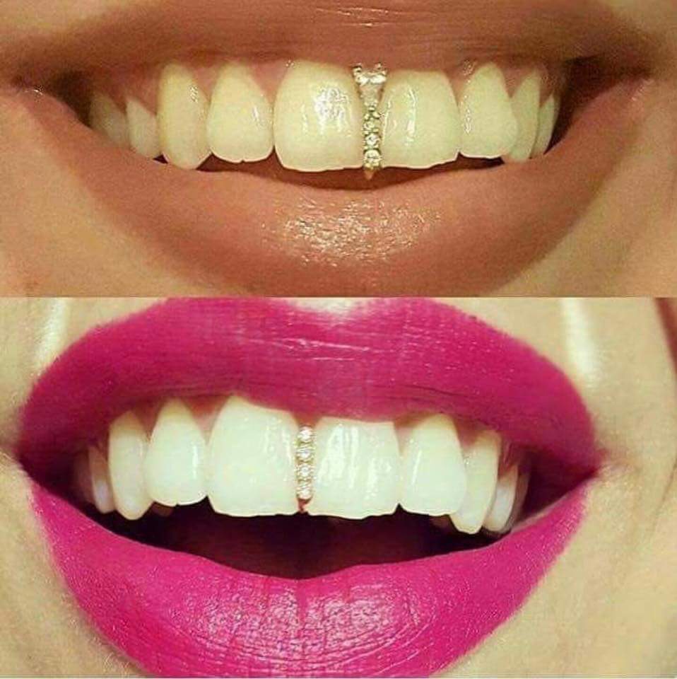 How to fix front gap teeth