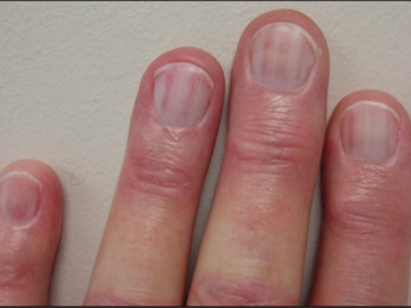 9 Symtomatic Types Of Nails And What They Could Indicate About Your Health  - Health - Nigeria