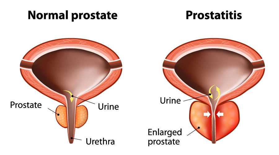 a prostatitis gyümölcs kezelése