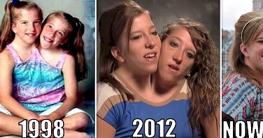 Conjoined twins Abby and Brittany Hensel the chances of survival for such  twins are usually very low but they live to aldulthood and become teachers  - iFunny Brazil