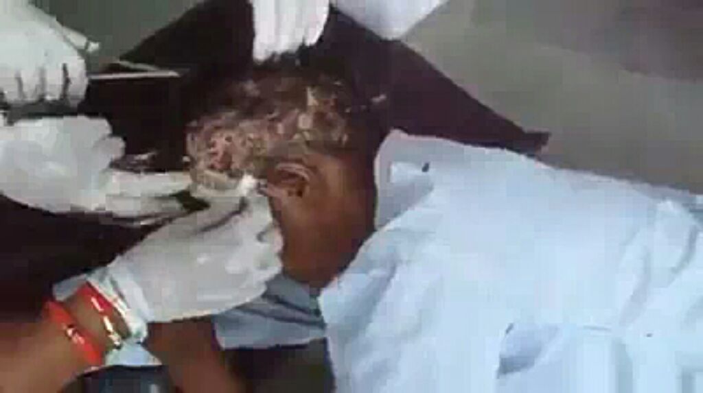 Graphi; Video /pic Of Maggot Infested Head Of A Lady After Using Brazilian  Hair. - Health - Nigeria