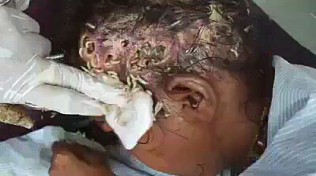 Graphi; Video /pic Of Maggot Infested Head Of A Lady After Using