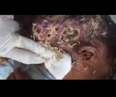 What Dirtyness Can Cause:maggots Coming Out Of Woman's Head