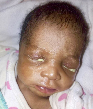 Baby With Eye Infection Abandoned In Abuja (Disturbing ...