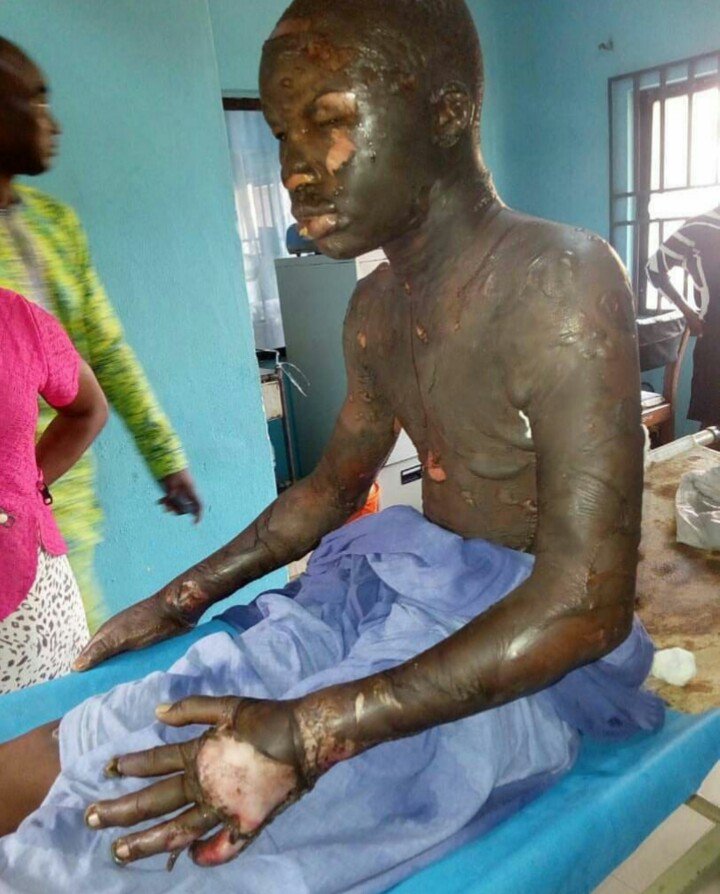 Woman pours kerosene on only son And sets him on fire for stealing mp3