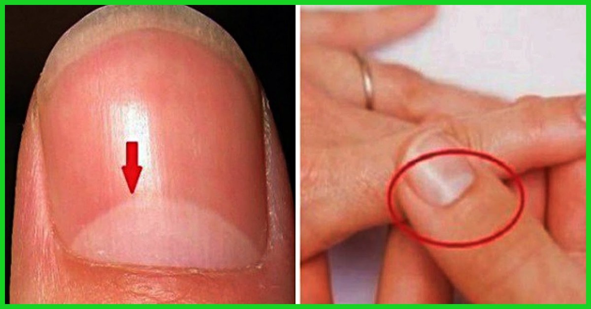 Check Out What White Spots On Your Nails Indicate - Romance - Nigeria