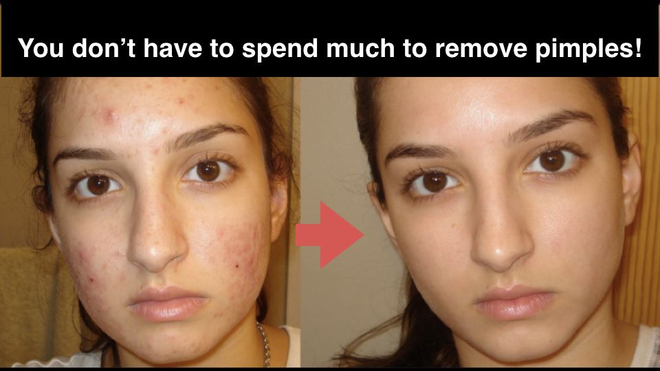 To acne of rid quickest way get the 4 Ways