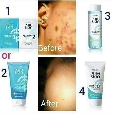 Get Rid Of Pimples And Spots With Oriflame Pure Skin Set Health Nigeria