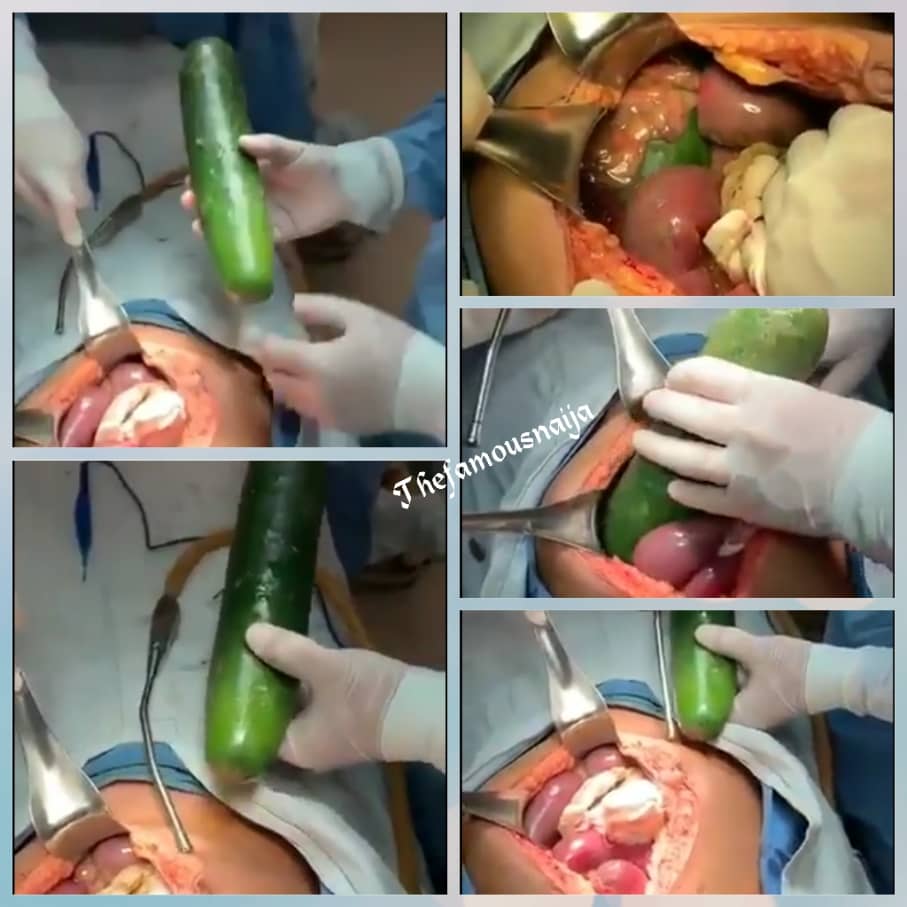 Image result for Doctors Remove Huge Cucumber From Lady's Body