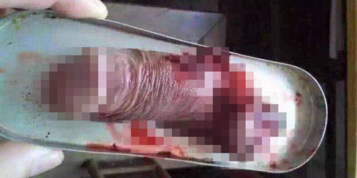 Woman Cut Off Ex-husband’s Manhood, Flushes It Down The Toilet (graphic Pho...