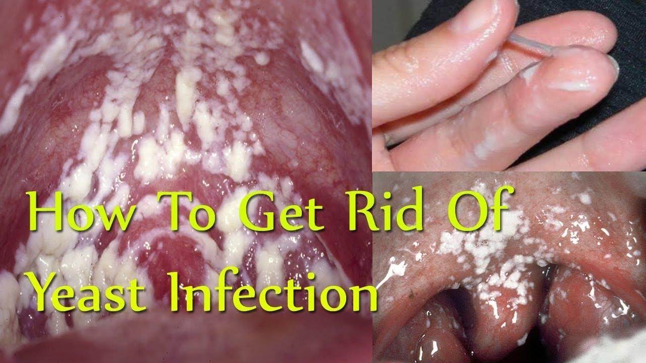 Vaginal Yeast Infection What Every Woman And Man Should Know And Solution -...